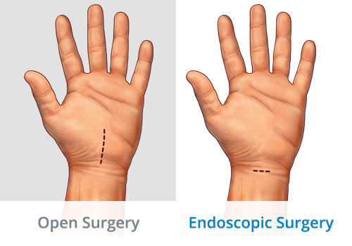 endoscopic-carpal-tunnel-release