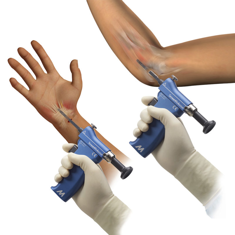 Endoscopic Carpal Tunnel Surgery Overland Park